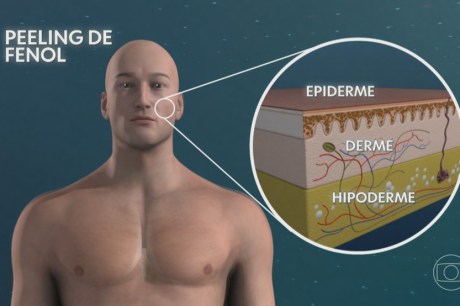 Anvisa proíbe produtos com fenol em procedimento de saúde ou estético