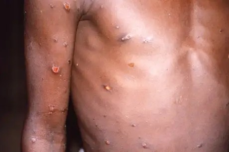 Mpox: conheça sintomas e tire principais dúvidas sobre a doença